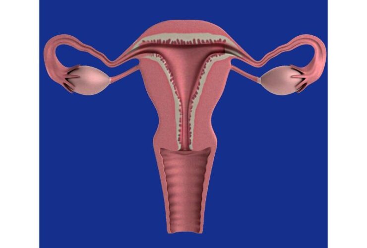 La Endometriosis y la lucha constante por la salud femenina Endometriosis